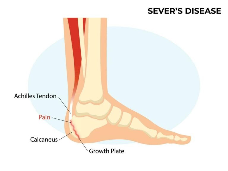सेवर रोग (Sever's Disease - बच्चों में एड़ी का दर्द)