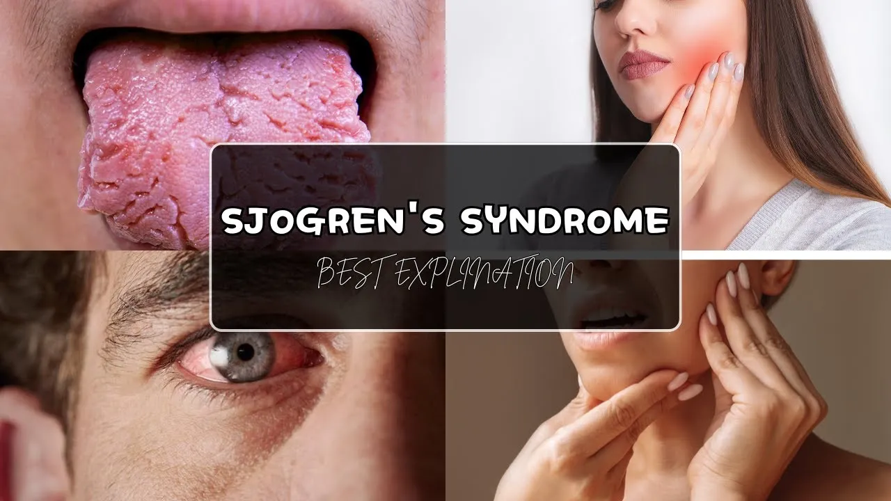सोग्रेन सिंड्रोम (Sjögrens Syndrome - आंखों और मुंह का अत्यधिक सूखना)
