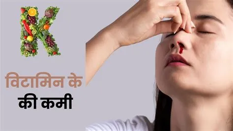 स्कर्वी (Scurvy - विटामिन सी की कमी से मसूड़ों से खून आना)