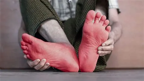 स्क्लेरोडैक्टली (Sclerodactyly - उंगलियों की त्वचा का सख्त और मोटा होना)