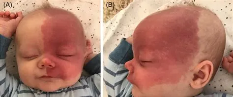स्टर्ज-वेबर सिंड्रोम (Sturge-Weber Syndrome - चेहरे पर जन्मजात लाल निशान और मस्तिष्क विकार)