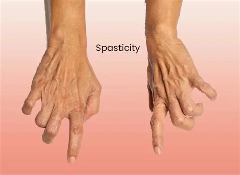 स्पास्टिसिटी (Spasticity - मांसपेशियों में लगातार जकड़न)