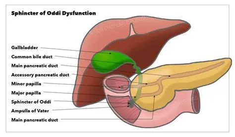 स्फिंक्टर ऑफ ओड्डी डिसफंक्शन (Sphincter of Oddi Dysfunction)