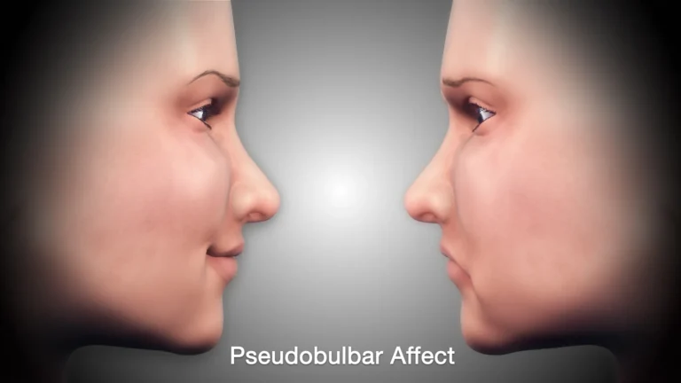 स्यूडोबुलबार अफेक्ट (Pseudobulbar Affect - PBA - अचानक हंसना या रोना)