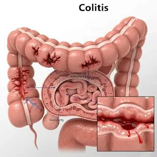 स्यूडोमेम्ब्रेनस कोलाइटिस (Pseudomembranous Colitis - सी. डिफ संक्रमण)