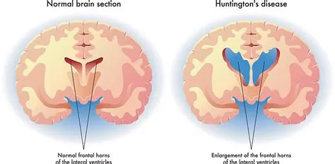हंटिंगटन कोरिया (Huntington's Chorea)