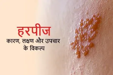 हरपीज जोस्टर ऑप्थेल्मिकस (Herpes Zoster Ophthalmicus - आंख में शिंगल्स)