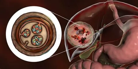 हाइडैटिड सिस्ट रोग (Hydatid Cyst Disease / Echinococcosis - कुत्तों से फैलने वाला टेपवर्म)