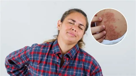 हाइड्राडेनाइटिस सप्पुरतिवा (Hidradenitis Suppurativa - पसीने की ग्रंथियों का संक्रमण)
