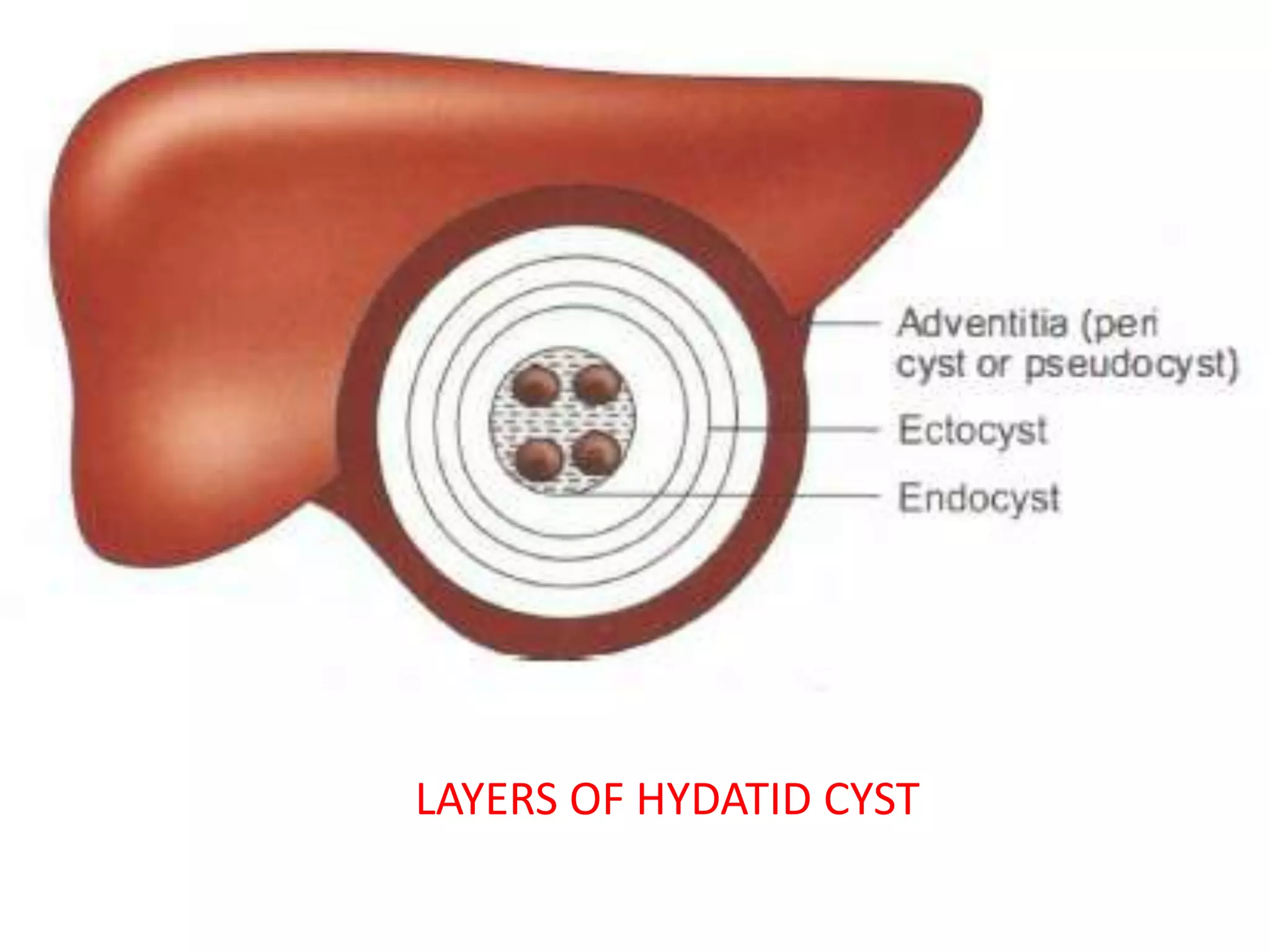 हाइड्रैटिड रोग (Hydatid Disease - इचिनोकोकोसिस)