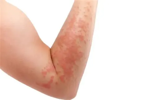 हाइपरकेराटोसिस (Hyperkeratosis - त्वचा की बाहरी परत का मोटा होना)
