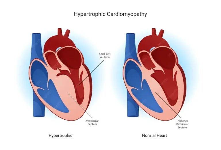हाइपरट्रॉफिक कार्डियोमायोपैथी (Hypertrophic Cardiomyopathy)