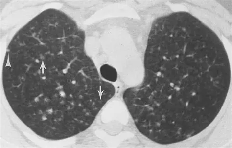 हाइपरसेंसिटिविटी न्यूमोनाइटिस (Hypersensitivity Pneumonitis - धूल-कणों से फेफड़ों की एलर्जी)
