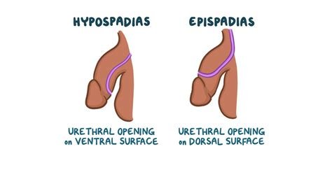 हाइपोस्पेडियास (Hypospadias)