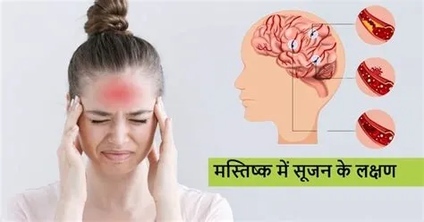 हाई एल्टीट्यूड सेरेब्रल एडिमा (HACE - ऊंचाई पर मस्तिष्क में सूजन)