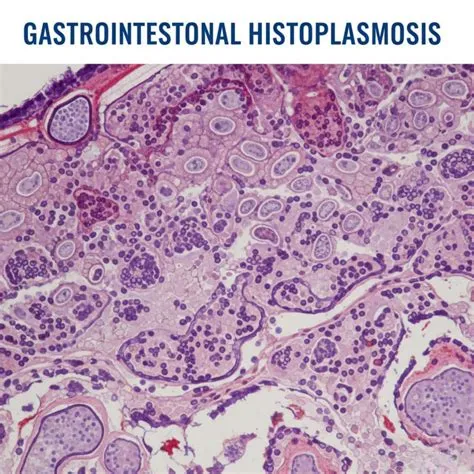 हिस्टोप्लास्मोसिस (Histoplasmosis - फंगल संक्रमण)
