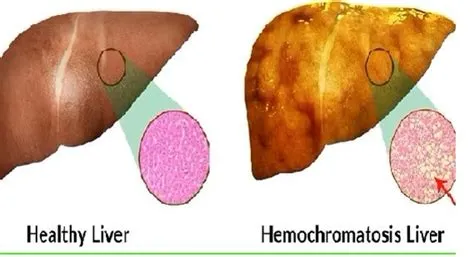हेमोक्रोमैटोसिस (Hemochromatosis - लिवर और अन्य अंगों में आयरन का जमाव)