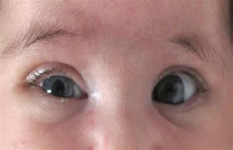 होर्नर सिंड्रोम (Horner's Syndrome - नसों के नुकसान से आंख का छोटा दिखना)