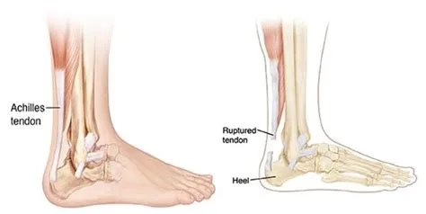 अकिलीज़ टेंडन रप्चर (Achilles Tendon Rupture - एड़ी की नस का पूरी तरह फटना)