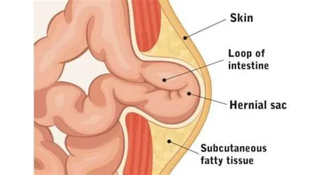 अम्बिलिकल हर्निया (Umbilical Hernia - नाभि का हर्निया)