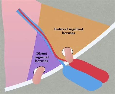 इंगुइनल हर्निया (Inguinal Hernia - जांघ के पास हर्निया)