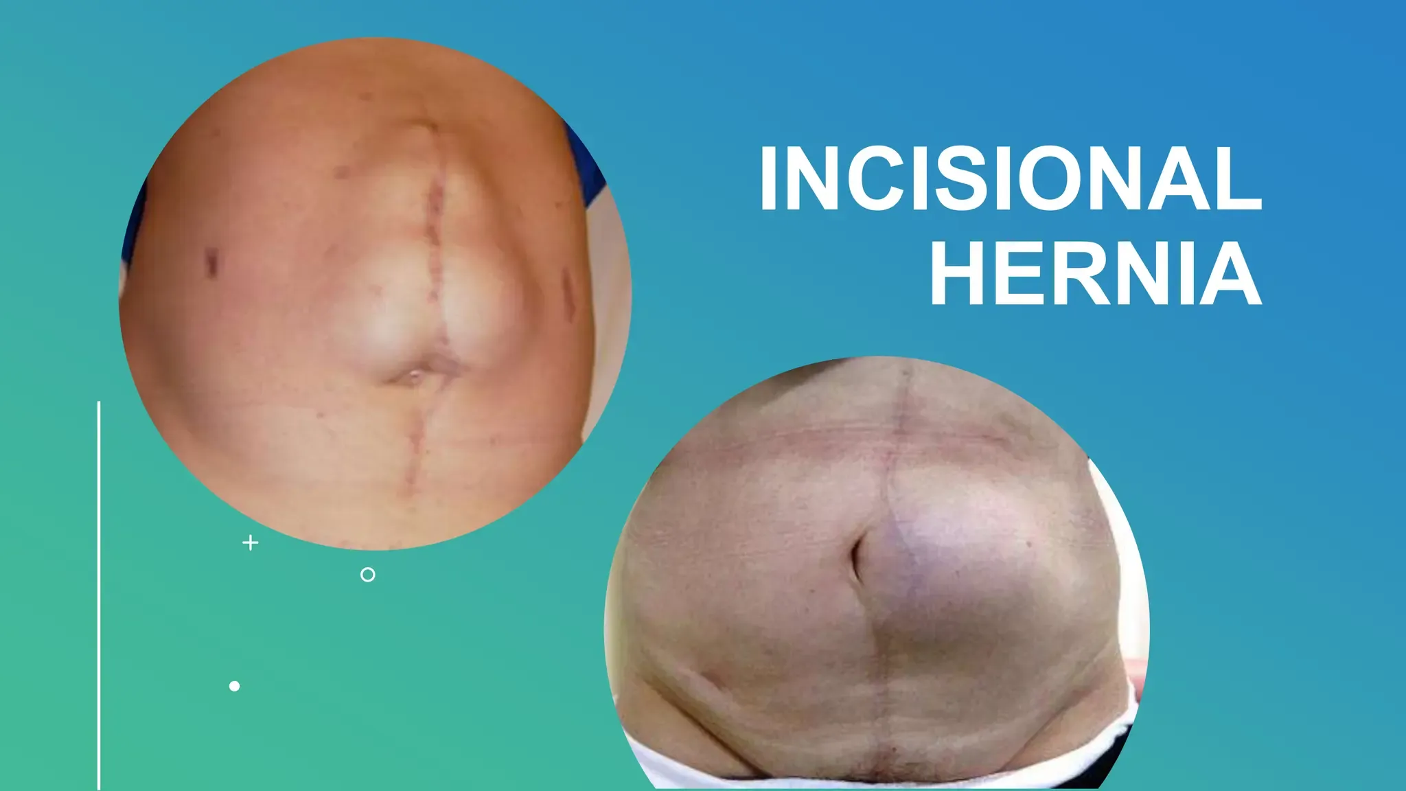 इन्सिजनल हर्निया (Incisional Hernia - सर्जरी के पुराने निशान पर हर्निया)
