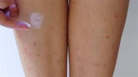 इम्पेटिगो (Impetigo - बच्चों में त्वचा का जीवाणु संक्रमण)