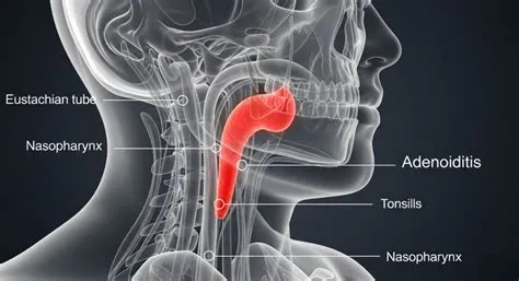 एडिनोइडाइटिस (Adenoiditis - एडिनोइड्स की सूजन)