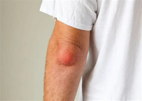 ऑलेक्रेनॉन बर्साइटिस (Olecranon Bursitis - कोहनी की थैली में सूजन और पानी भरना)