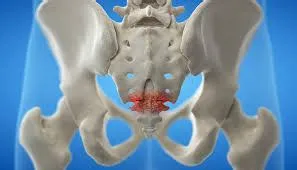 कॉक्सीडीनिया (Coccydynia - टेलबोन या पूंछ की हड्डी का गंभीर दर्द)