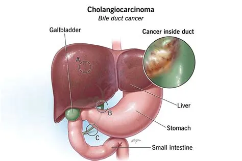 कोलेंजाइटिस (Cholangitis - पित्त नली का संक्रमण)