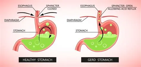 गैस्ट्रोएसोफेगल रिफ्लक्स डिजीज (GERD - एसिड रिफ्लक्स)