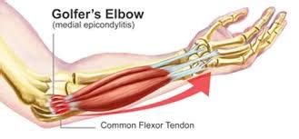 गोल्फर एल्बो (Golfer's Elbow / Medial Epicondylitis - कोहनी के अंदरूनी हिस्से का दर्द)