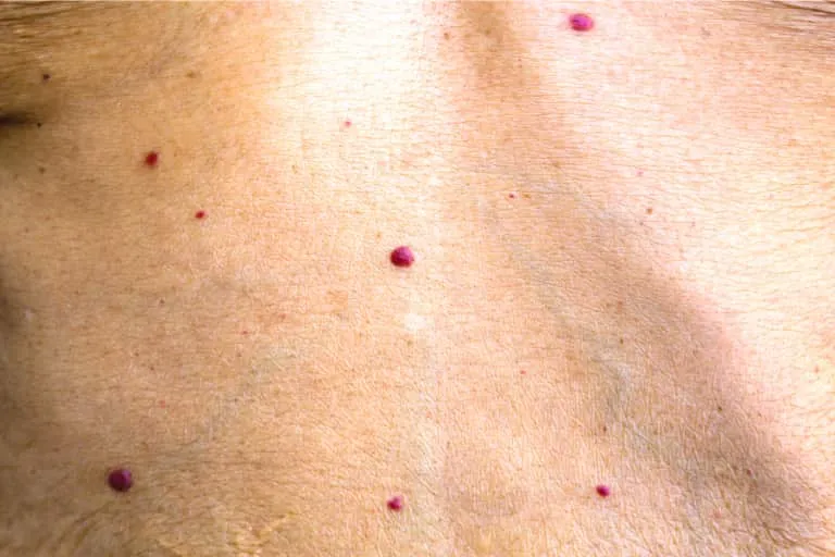 चेरी एंजियोमा (Cherry Angioma - त्वचा पर लाल रंग के छोटे मस्से)