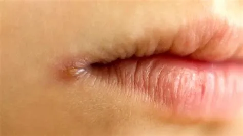 चेलाइटिस (Cheilitis - होठों की सूजन और फटना)