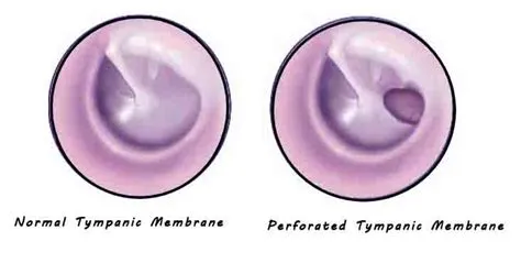 टिम्पैनिक मेम्ब्रेन परफोरेशन (Tympanic Membrane Perforation - कान का पर्दा फटना)