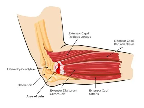 टेनिस एल्बो (Tennis Elbow / Lateral Epicondylitis - कोहनी के बाहरी हिस्से का दर्द)