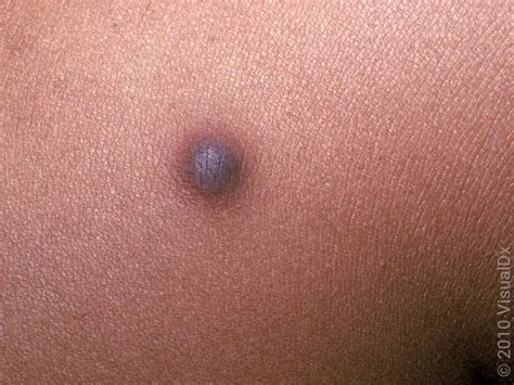 डर्माटोफाइब्रोमा (Dermatofibroma)