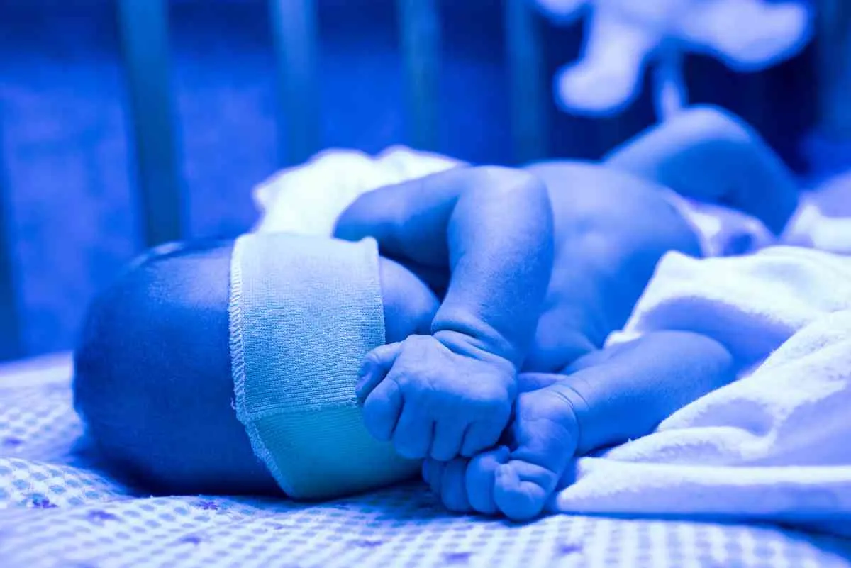 नवजात कामला (Neonatal Jaundice - नवजात शिशुओं में पीलिया)