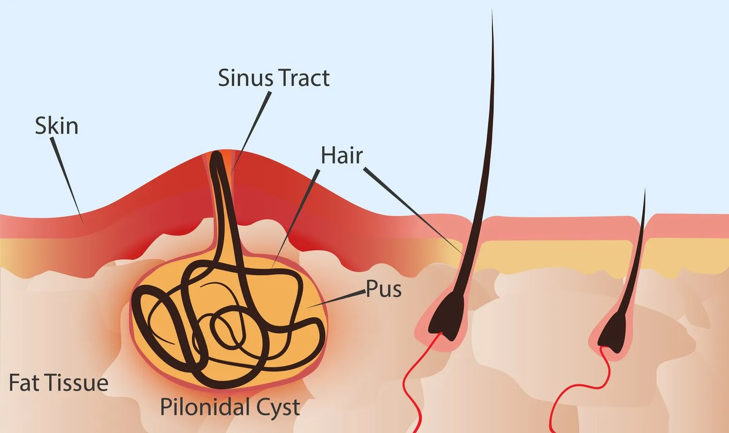 पिलोनिडल सिस्ट (Pilonidal Cyst - टेलबोन के पास बालों की गांठ)