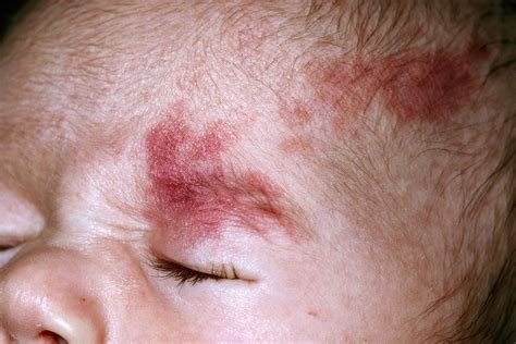 पोर्ट-वाइन स्टेन (Port-Wine Stain - चेहरे या शरीर पर जन्मजात लाल दाग)