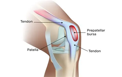प्रीपेलर बर्साइटिस (Prepatellar Bursitis - हाउसमेड्स नी / घुटने के आगे सूजन)