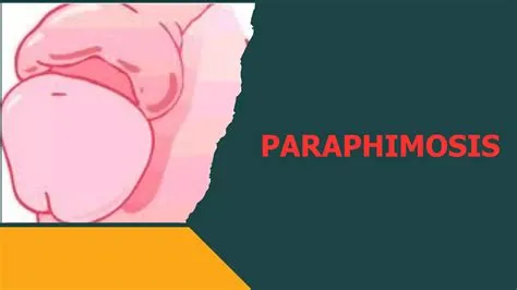 फाइमोसिस और पैराफाइमोसिस (Phimosis and Paraphimosis)