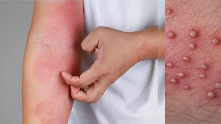 फॉलिकुलिटिस (Folliculitis - बालों की जड़ों में बैक्टीरियल संक्रमण)