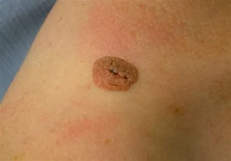 बेसल सेल पेपिलोमा (Basal Cell Papilloma / Seborrheic Keratosis)