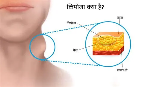 लिपोमा (Lipoma - चर्बी की हानिरहित गांठ)