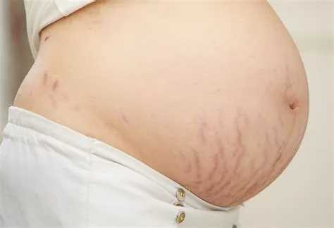 स्ट्रेच मार्क्स (Striae / Stretch Marks)
