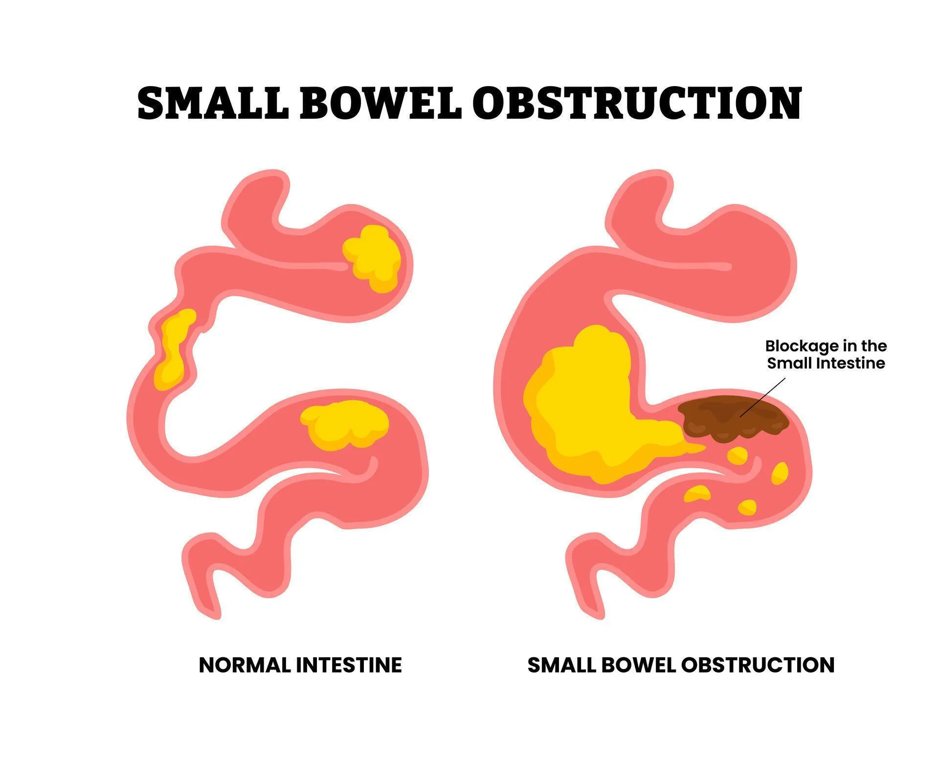स्मॉल बाउल ऑब्स्ट्रक्शन (Small Bowel Obstruction - छोटी आंत में रुकावट)