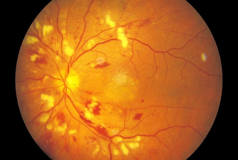 हाइपरटेंसिव रेटिनोपैथी (Hypertensive Retinopathy)
