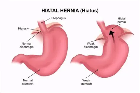 हायटल हर्निया (Hiatal Hernia - पेट का ऊपरी हिस्सा छाती की ओर खिसकना)
